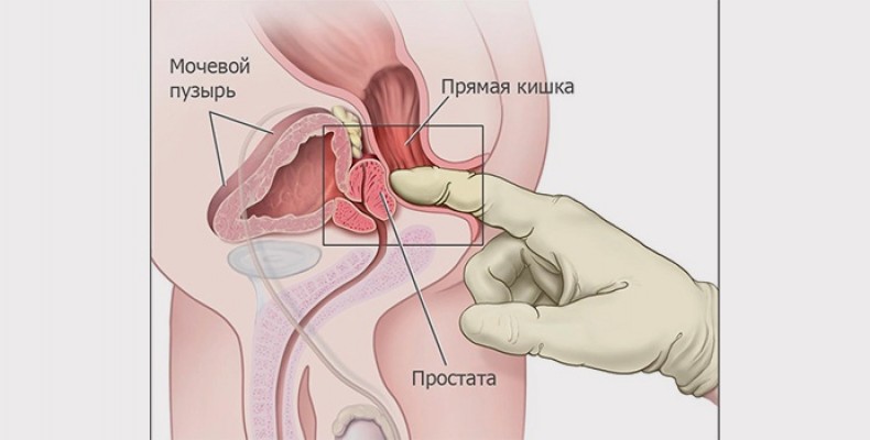 Умови попередження раку — передміхурової залози