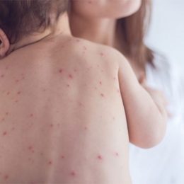 Чи є ще час і можливості протистояти кору?