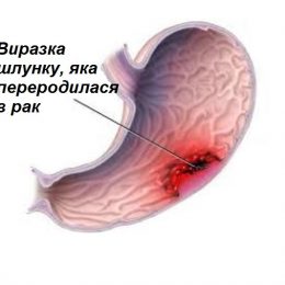 Рак шлунка: що потрібно знати кожній людині