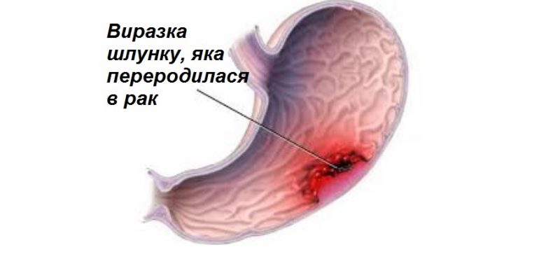 Рак шлунка: що потрібно знати кожній людині