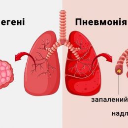 У МОЗ України розповіли про симптоми та лікування пневмонії