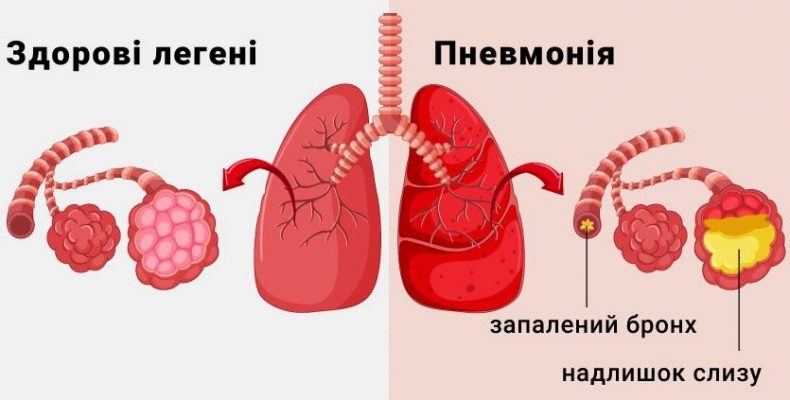 У МОЗ України розповіли про симптоми та лікування пневмонії